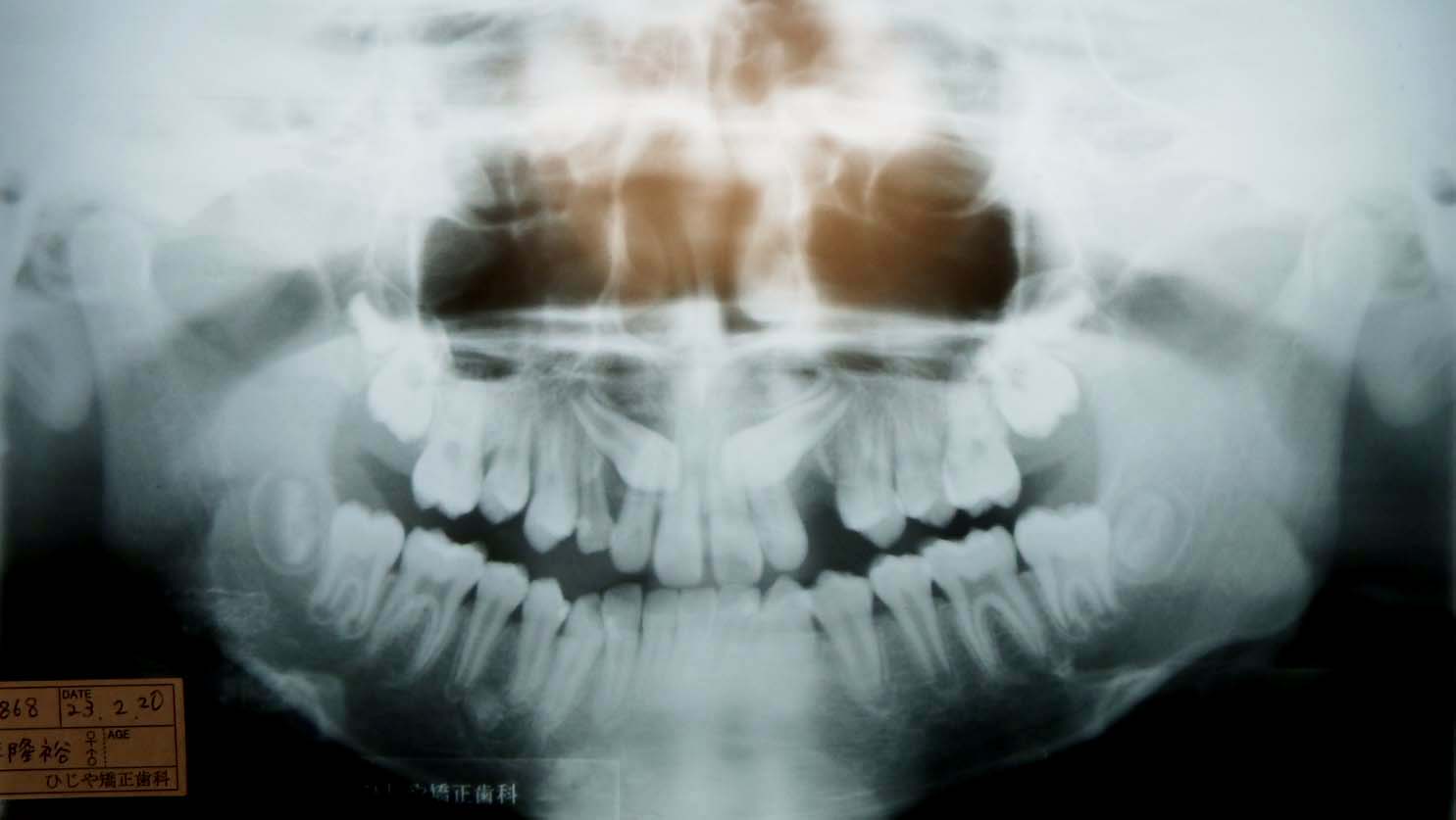 レントゲン 乳歯 25歳まで乳歯だった私…意外と多い「大人乳歯」 原因は？注意点は？