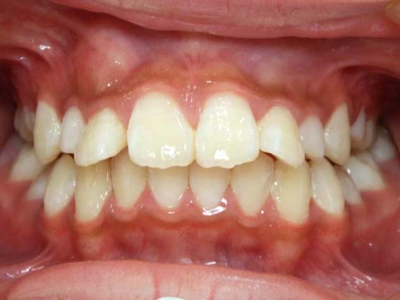 17年 2月 永臼歯の生える位置がずれて 前歯の根っこが吸収された症例