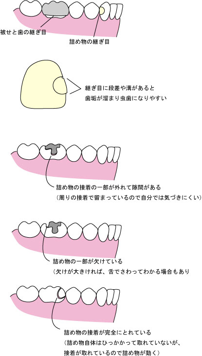 抜歯 怖い