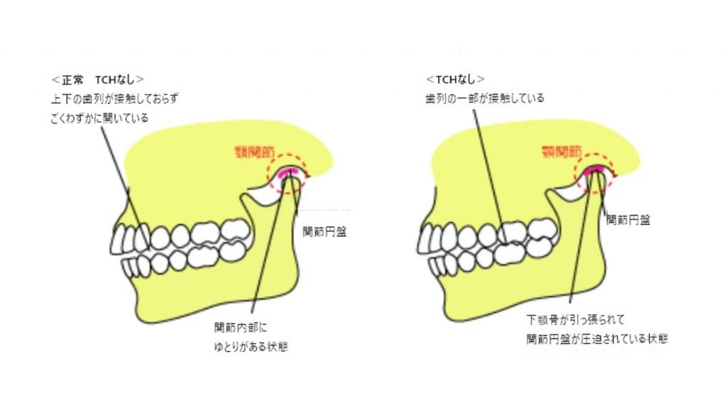 21年 ３月 歯列接触癖 ｔｃｈ