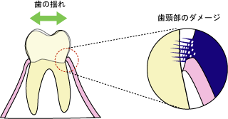 アブ フラクション