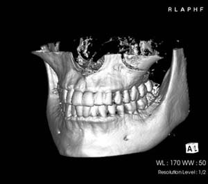 2014年　3月　知覚過敏を治そう！2　－進化する歯科材料－