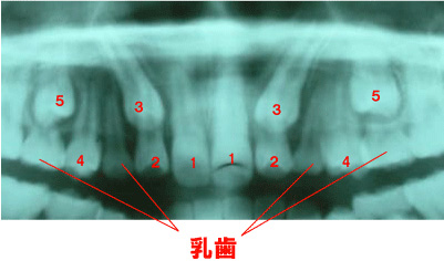 2014年　3月　知覚過敏を治そう！2　－進化する歯科材料－