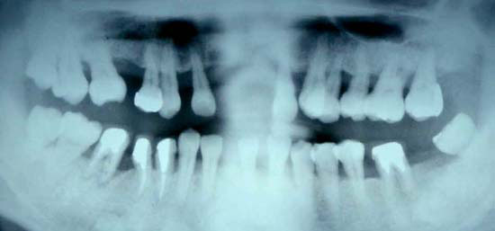 2014年9月　56歳　女性　下顎前突　全顎マルチブラケット症例