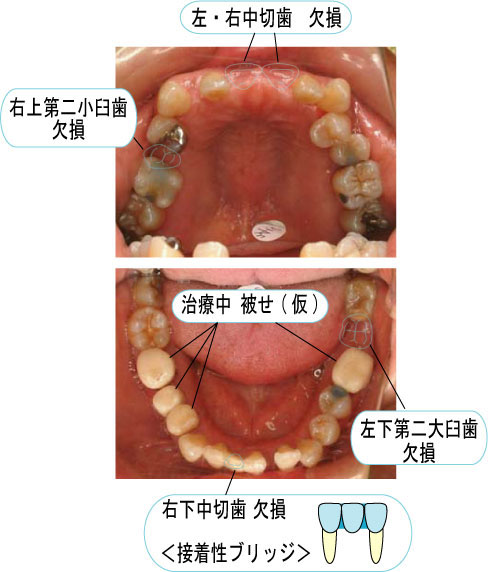 2014年10月　症例　入れ歯と歯周病と矯正治療　１