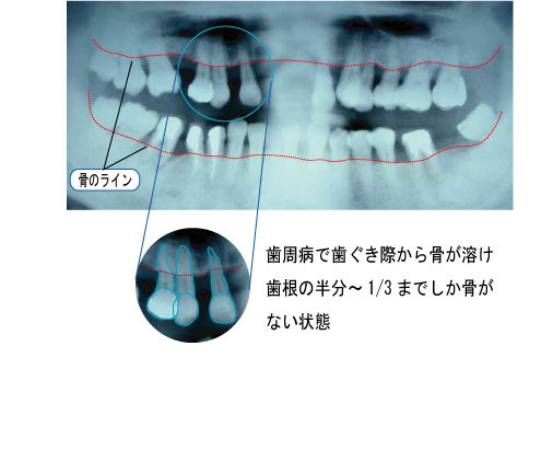 2014年10月　症例　入れ歯と歯周病と矯正治療　１