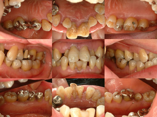 2014年10月　症例　入れ歯と歯周病と矯正治療　１