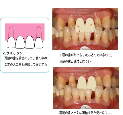 2014年10月　症例　入れ歯と歯周病と矯正治療　１