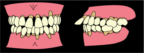 2014年10月　症例　入れ歯と歯周病と矯正治療　１