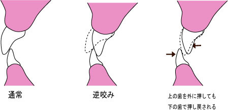 2014年10月　症例　入れ歯と歯周病と矯正治療　１