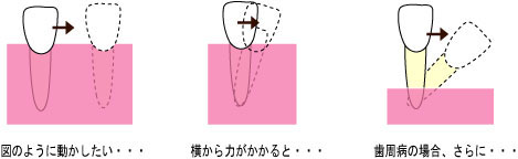 2014年10月　症例　入れ歯と歯周病と矯正治療　１