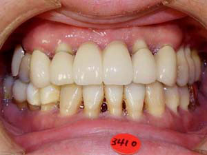 2014年10月　症例　入れ歯と歯周病と矯正治療　１