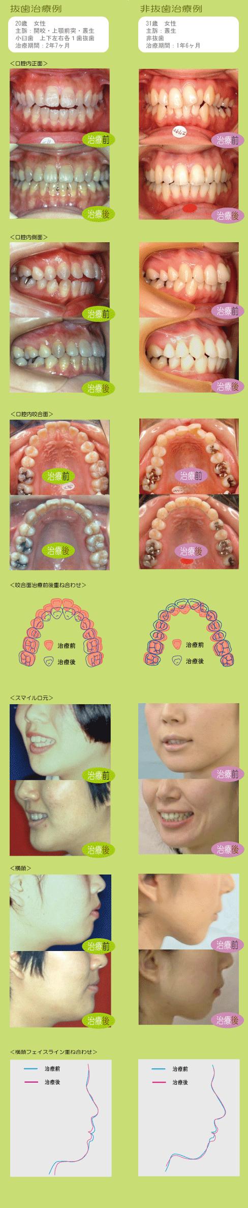 抜歯と非抜歯